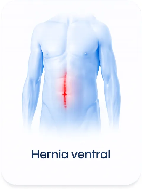 Hernia ventral